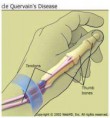 /album/sindrome-di-de-quervain/a10397989-1631733710387073-1575806101097058910-n-jpg/